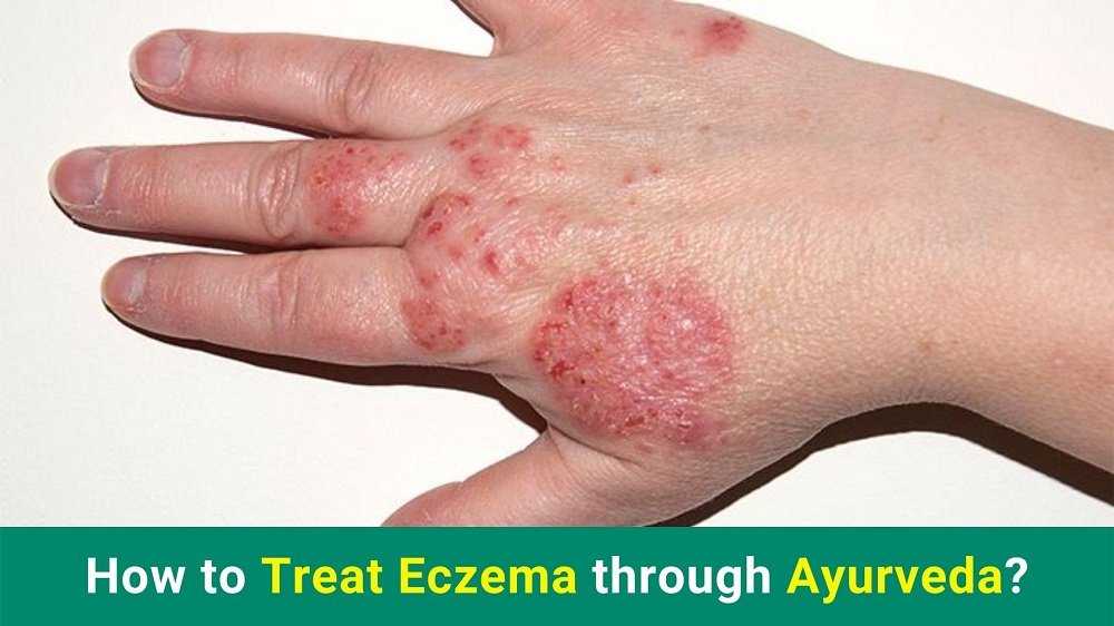 How to Treat Eczema through Ayurveda?