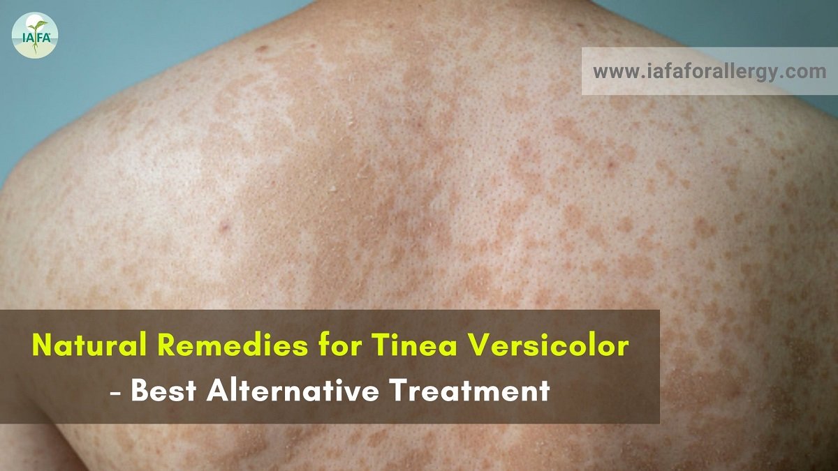 Natural Remedies for Tinea Versicolor - Best Alternative Treatment