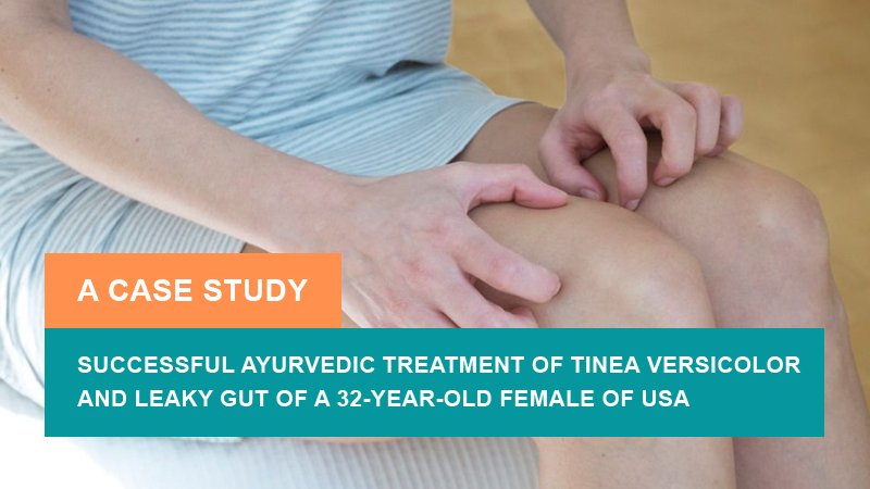 Successful Ayurvedic Treatment of Tinea Versicolor and Leaky Gut Syndrome - A Case Study