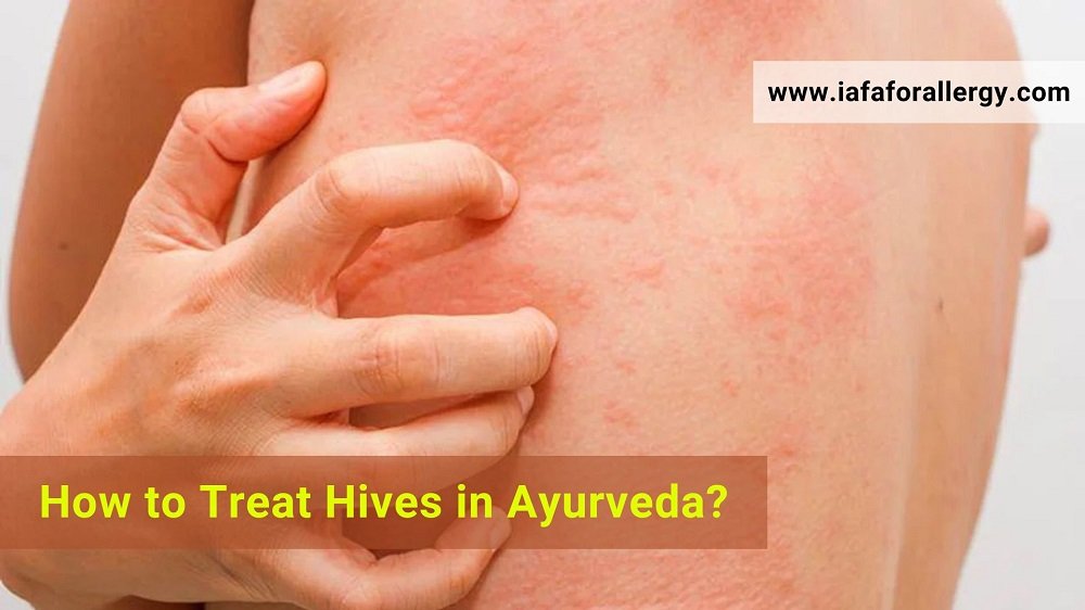 Treat Hives in Ayurveda