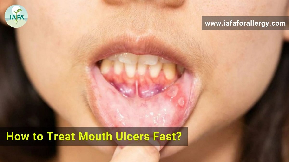 How to Treat Mouth Ulcers Fast?