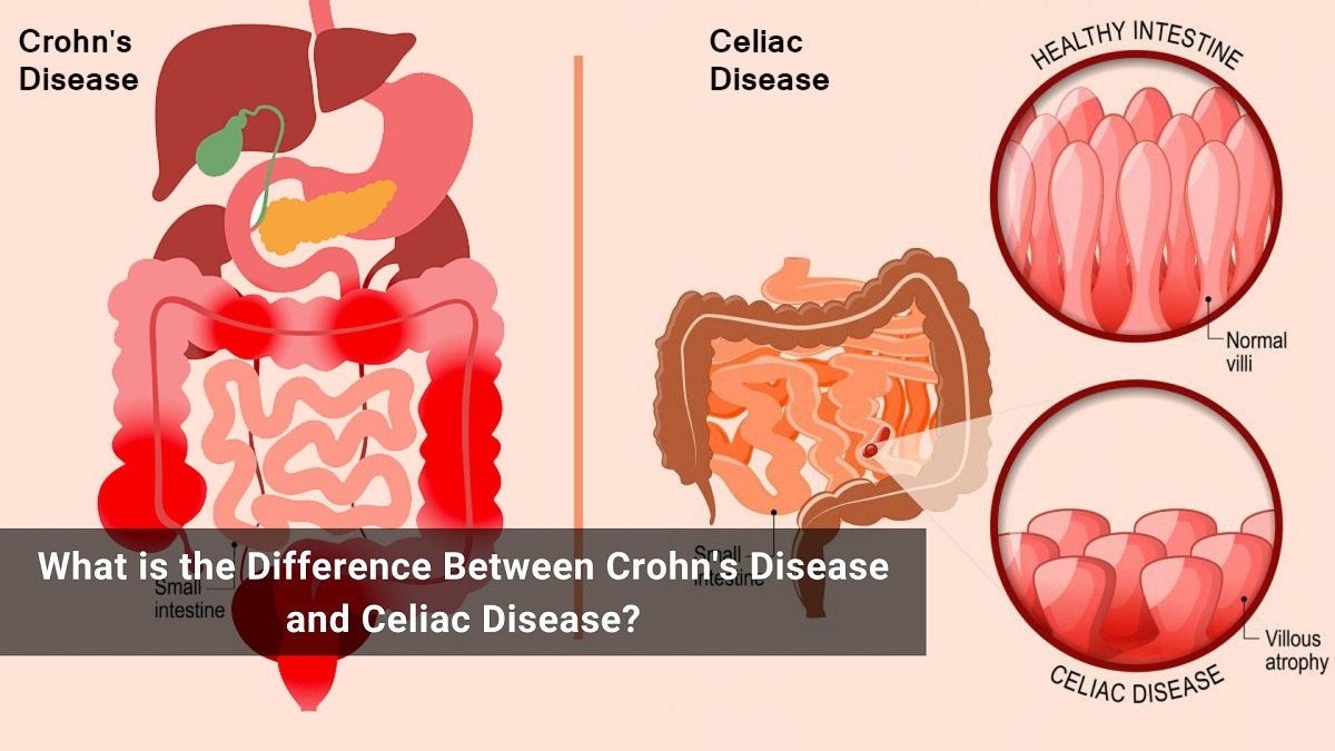 What Is The Difference Between Crohn s Disease And Celiac Disease 