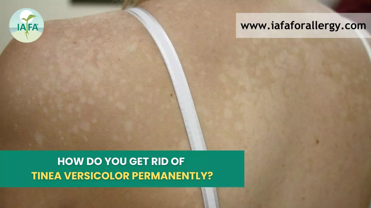 How Do You Get Rid of Tinea Versicolor Permanently?