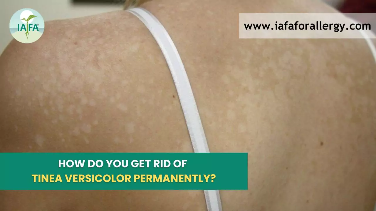 https://www.iafaforallergy.com/wp-content/uploads/2022/10/tinea-versicolor-permanently.webp