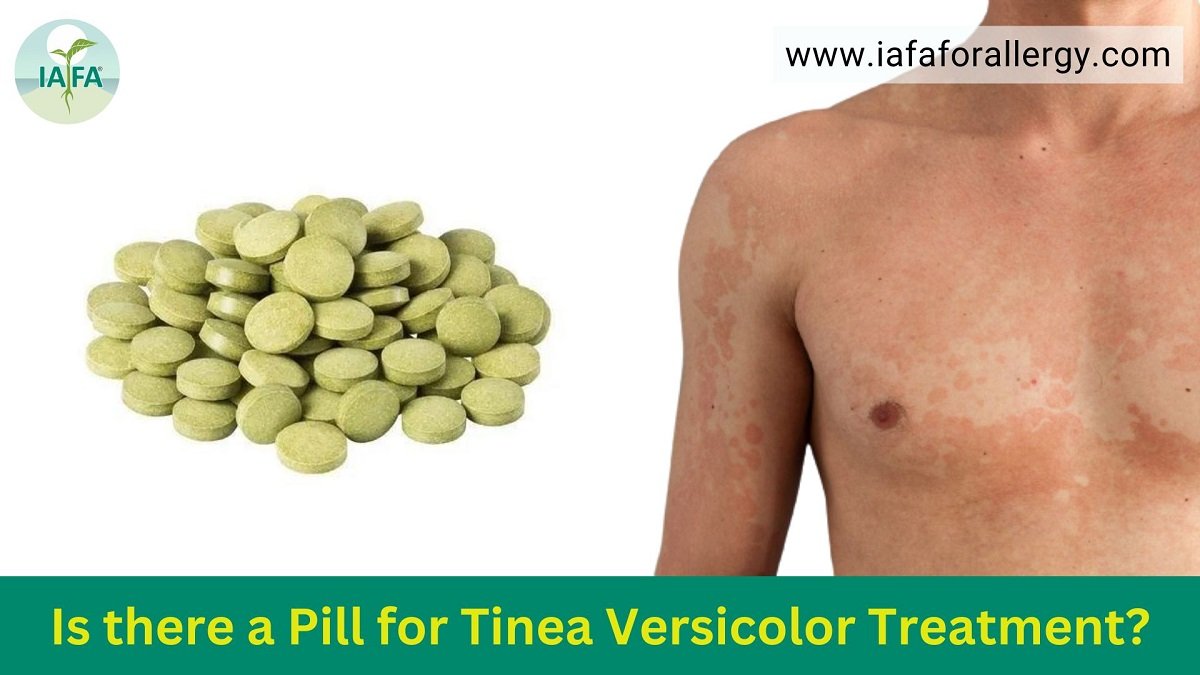 Is there a Pill for Tinea Versicolor Treatment?