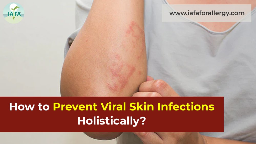 Viral Skin Infections