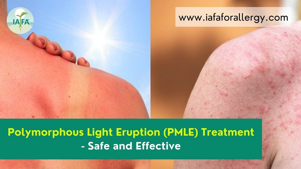 spurv Stedord Danmark Polymorphous Light Eruption (PMLE) Treatment – Safe and Effective