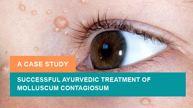 Successful Ayurvedic Treatment of Molluscum Contagiosum - A Case Study