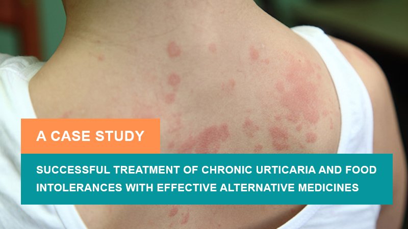 Successful Treatment of Chronic Urticaria and Food Intolerances with Effective Alternative Medicines - A Case Study