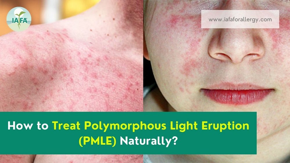 Treat Polymorphous Light Eruption - PMLE