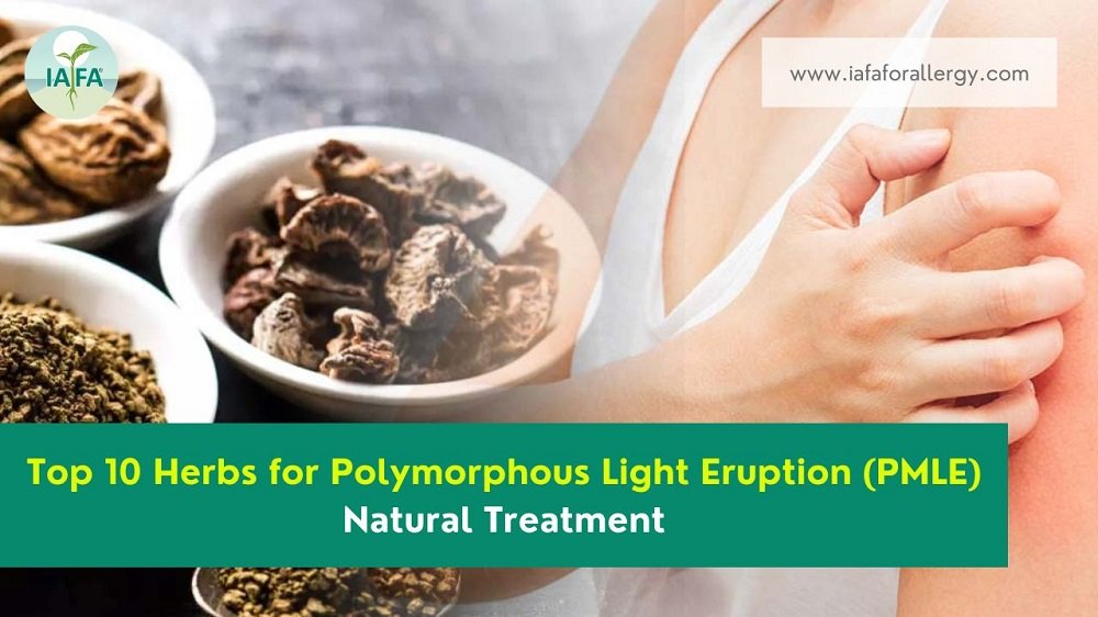 Top 10 Herbs for Natural Treatment of Polymorphous Light Eruption (PMLE)