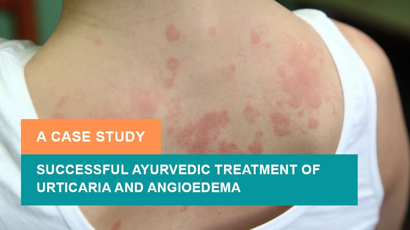 Successful Ayurvedic Treatment of Urticaria and Angioedema - A Case Study