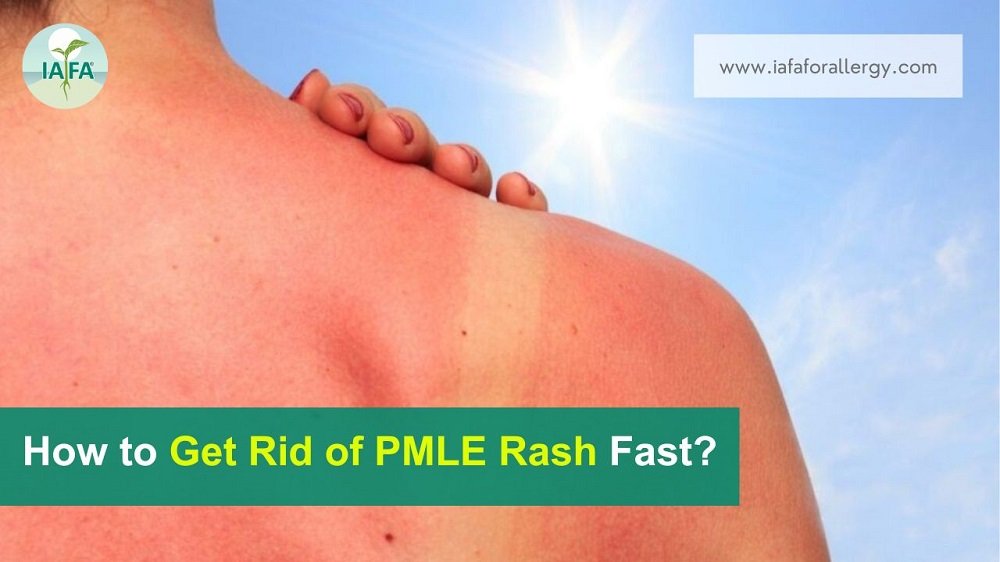 How to Get Rid of PMLE Rash Fast?
