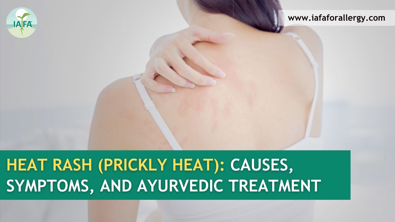 Ayurvedic Treatment for Heat Rash