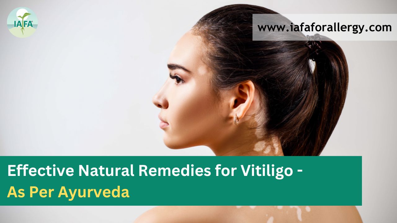 Natural Remedies for Vitiligo