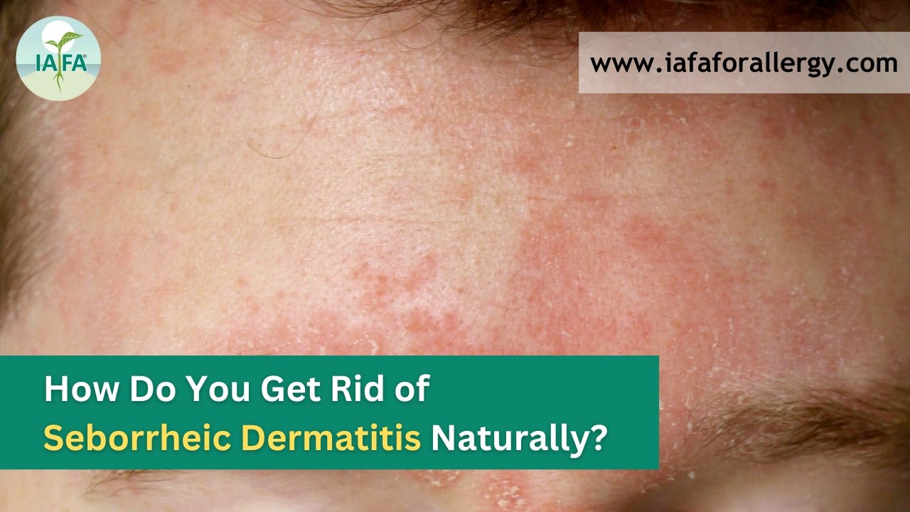how to get rid of seborrheic dermatitis naturally