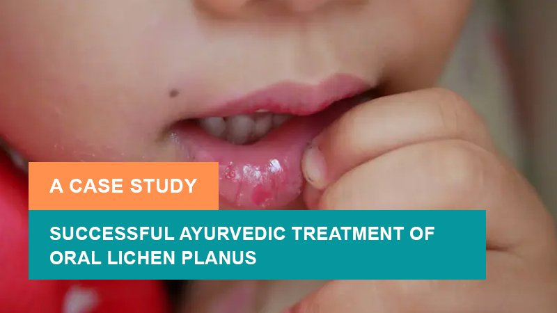 Successful Ayurvedic Treatment of Oral Lichen Planus - A Case Study