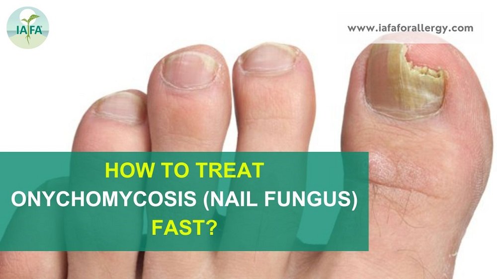 How to Treat Onychomycosis (Nail fungus) Fast?