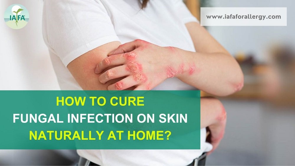 How to Cure Fungal Infection on Skin Naturally at Home?