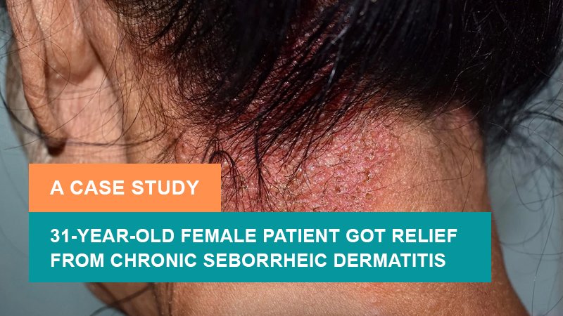 31-Year-Old Female Patient Got Relief from Chronic Seborrheic Dermatitis - A Case Study