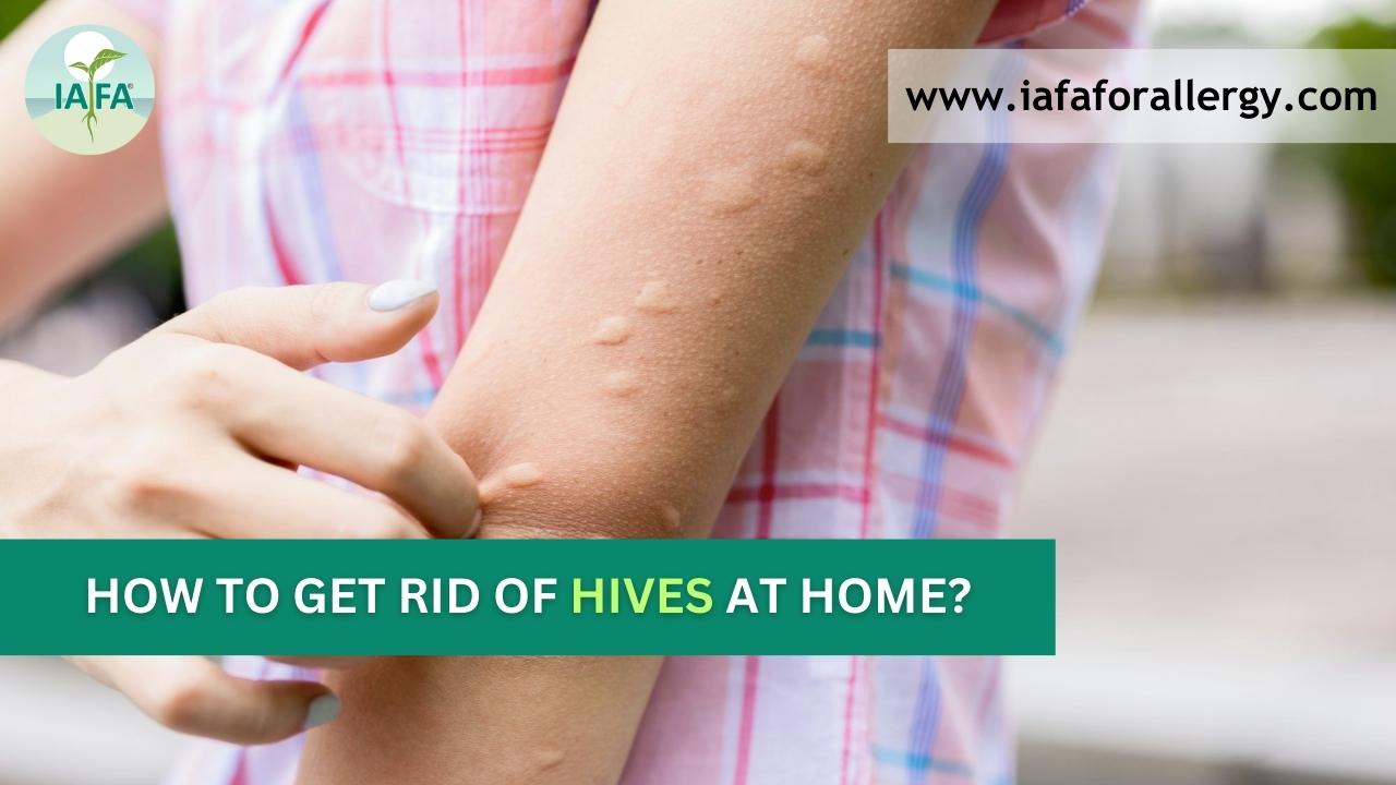 How to Get Rid of Hives at Home?