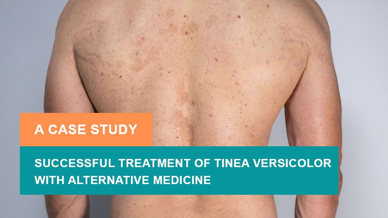 Successful Treatment of Tinea Versicolor with Alternative Medicine - A Case Study