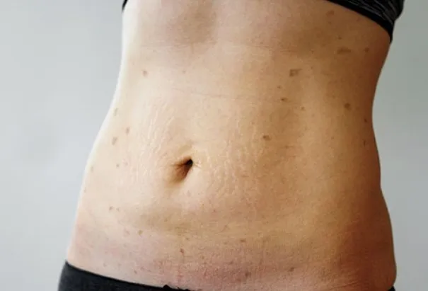 Lichen Planus Ayurvedic Treatment - Types, Causes, Symptoms and More