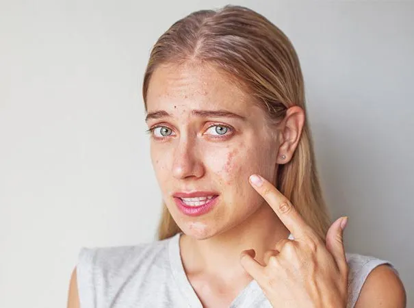 Manage Makeup Allergy IAFA