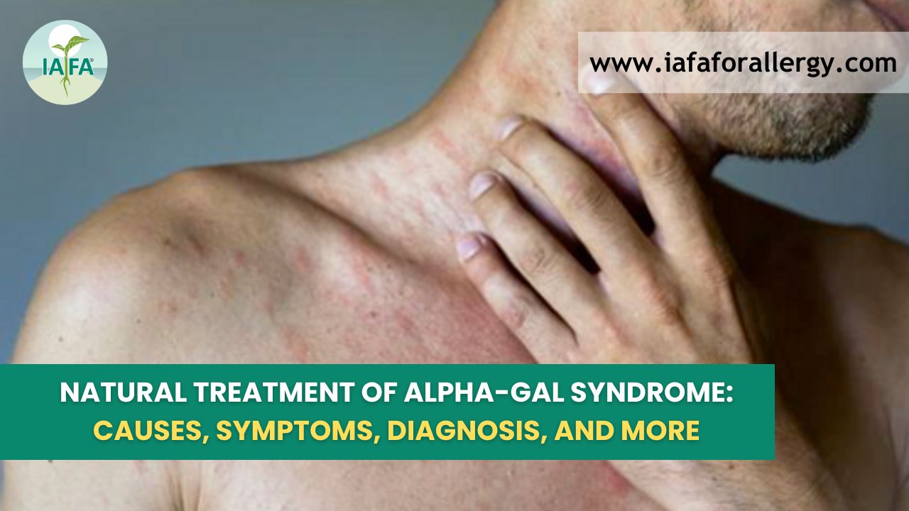 Natural Treatment of Alpha-gal Syndrome