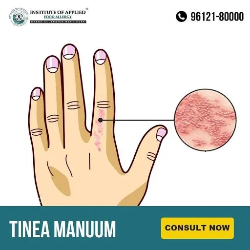 Tinea Manuum