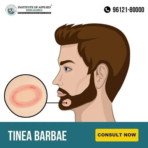 Tinea Barbae