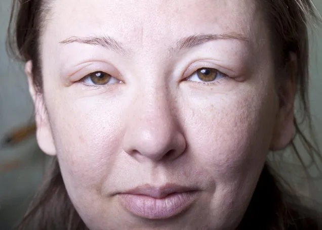Ayurvedic Treatment of Angioedema - Causes, Symptoms