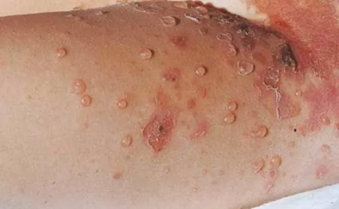 Ayurvedic Treatment for Bullous Disease - Types, Causes, Symptoms and More