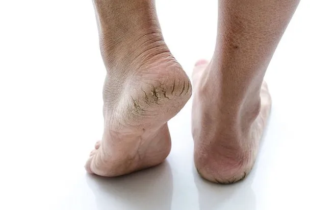 Heel fissures (cracked heels) | PhysioQinetics