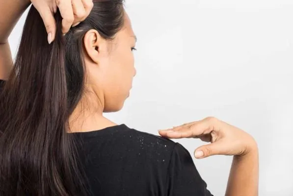 Dandruff Treatment in Ayurveda - Causes, Symptoms, and More