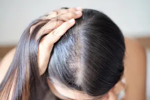 Hair Loss - Causes, Symptoms and Treatment
