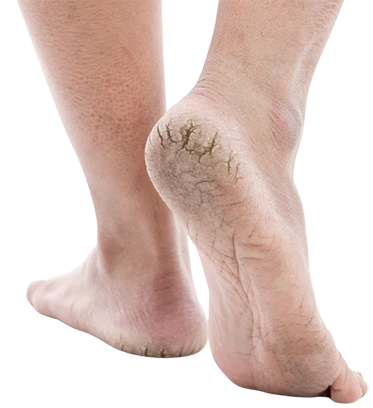 Cracked Heels Ayurvedic Treatment