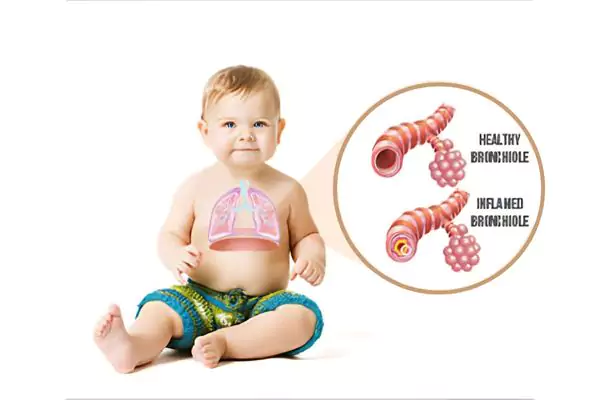 Natural Treatment for Bronchiolitis - Causes, Symptoms and More