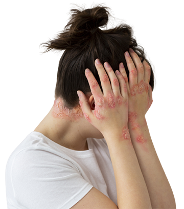 Contact Dermatitis Ayurvedic Treatment