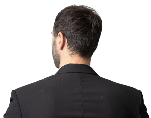 Dandruff Treatment in Ayurveda - Causes, Symptoms, and More
