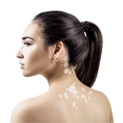 Ayurvedic Treatment of Pityriasis Alba - Causes and Symptoms
