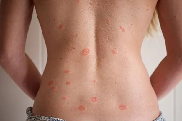 Pityriasis Rosea