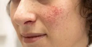Rosacea - Causes, Symptoms and Ayurvedic Treatment
