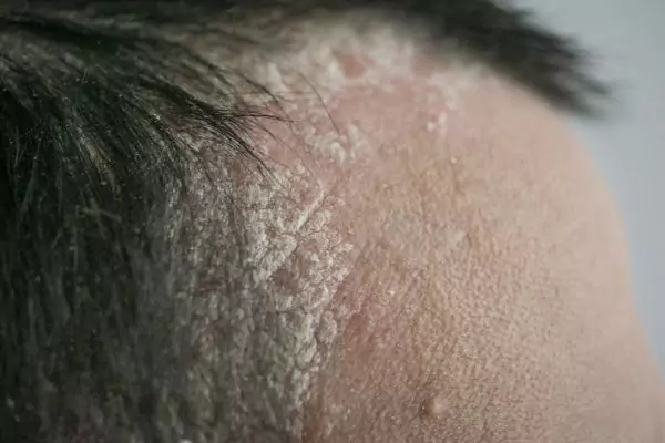 Seborrheic Dermatitis - Causes, Symptoms and Ayurvedic Treatment