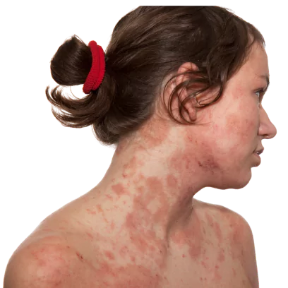 Manage Seborrheic Dermatitis