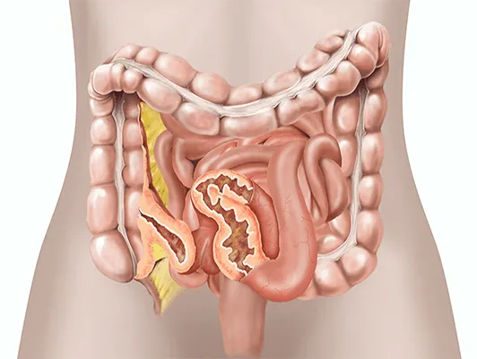Ulcerative Colitis Ayurvedic Treatment - Causes, Symptoms and More