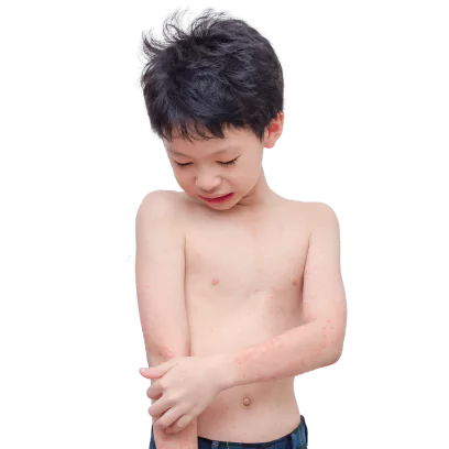 Urticaria - Causes, Symptoms and Ayurvedic Treatment