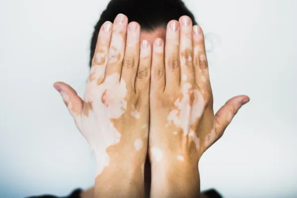 Vitiligo (Leucoderma) Ayurvedic Treatment - Types, Causes, Symptoms and More