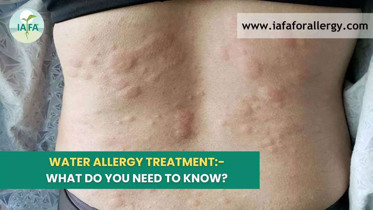Water Allergy Treatment - What Do You Need to Know?