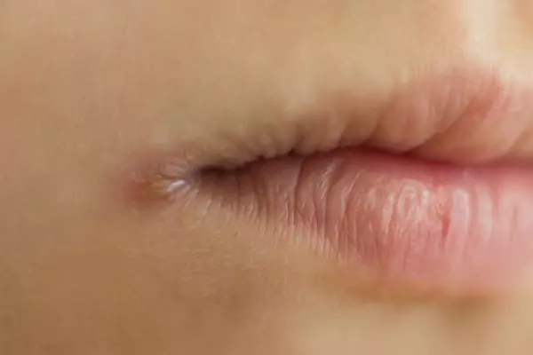 Manage Angular Stomatitis in Children